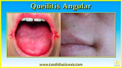 queilitis angular|Angular cheilitis